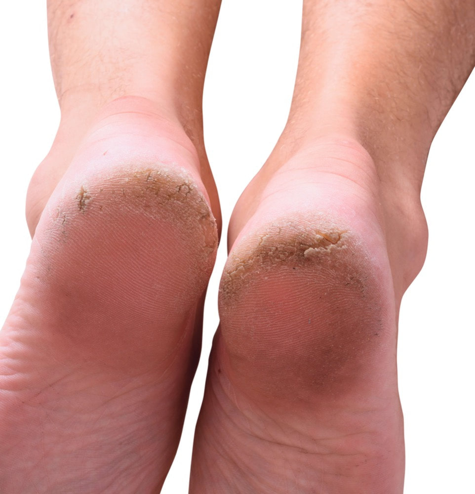 Podotherapie Hermanns | onder voet, eeltpit onder de voet, eeltpit onder voet behandeling