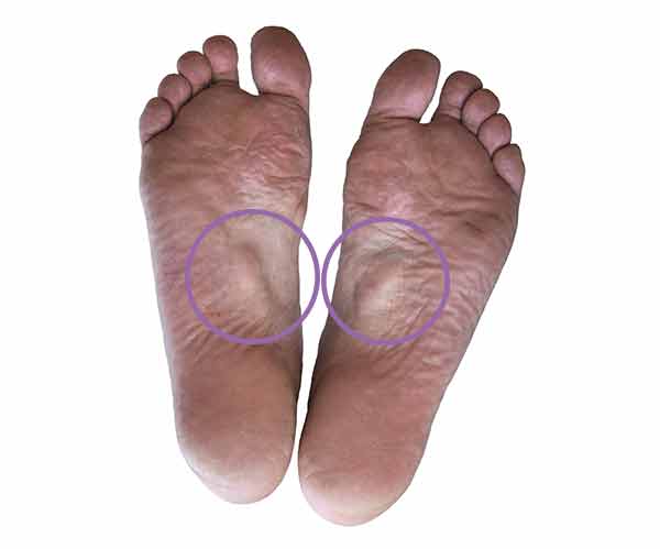 conversie formeel Trek Podotherapie Hermanns | bult onder voet, bult onder voeten, bult onder voet  behandelen