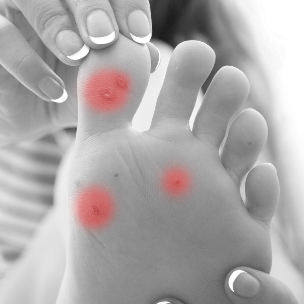 vijver Wie Leesbaarheid Podotherapie Hermanns | Blaren tenen, blaar teen, blaren tenen behandeling