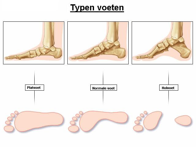 Rauw Eerlijk Verdienen Podotherapie Hermanns | doorgezakte voet, doorgezakte voeten, doorgezakte  voet behandelen