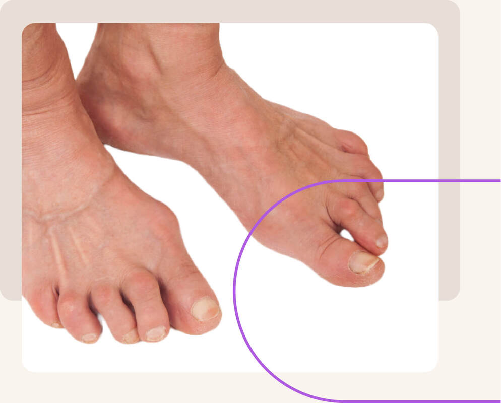 Podotherapie Hermanns | Reumatische voet, reuma voet, voeten reuma